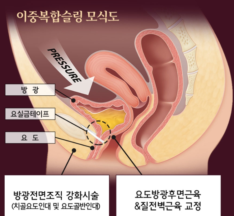 자궁하수? 18년차 대학병원 교수가 총정리합니다.