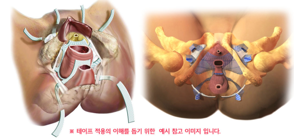 자궁탈출증 치료, 의사가 수술 하지 말라는 이유?