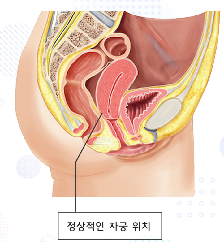 자궁탈출증 치료, 의사가 수술 하지 말라는 이유?