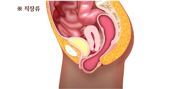 자궁탈출증 치료, 의사가 수술 하지 말라는 이유?