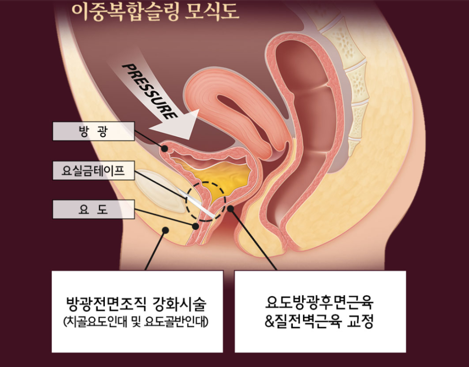 자궁탈출증 치료, 의사가 수술 하지 말라는 이유?