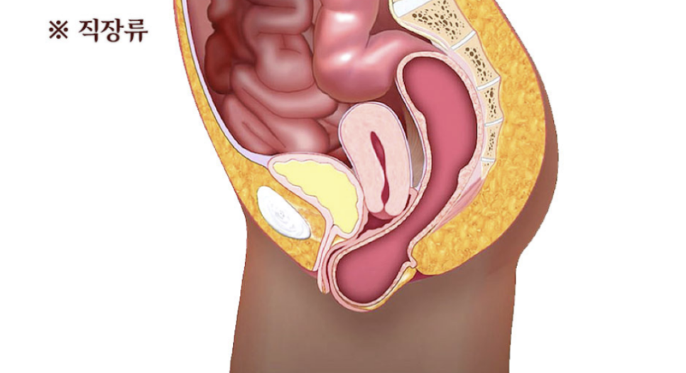 자궁하수? 18년차 대학병원 교수가 총정리합니다.