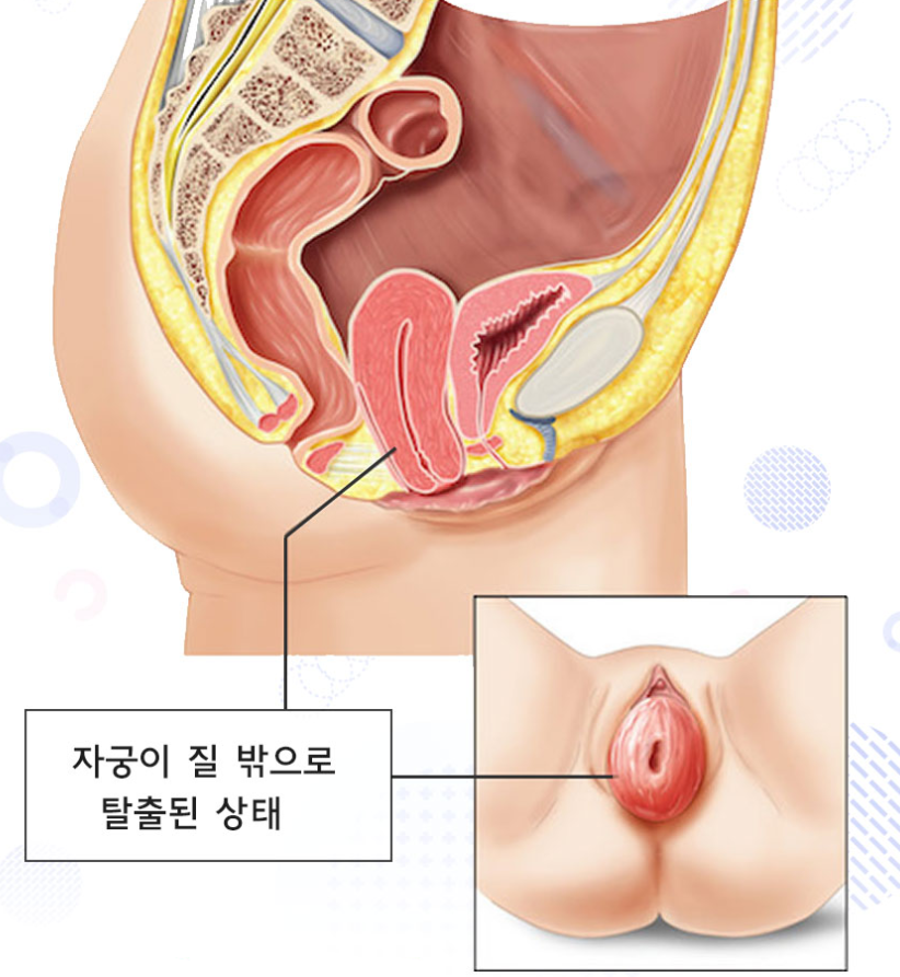 자궁하수? 18년차 대학병원 교수가 총정리합니다.