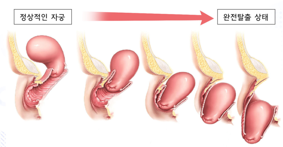 자궁탈출증 치료, 의사가 수술 하지 말라는 이유?