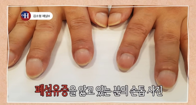 몸이 보내(13) : 손끝을 보면 폐암을 알수있다?!폐암 가능성을 알리는 손톱