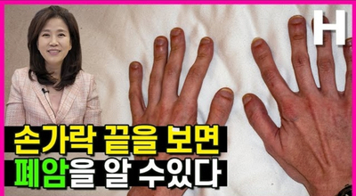 몸이 보내(13) : 손끝을 보면 폐암을 알수있다?!폐암 가능성을 알리는 손톱
