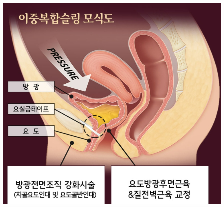 복압성요실금치료? 아무도 말해주지 않는 재발의 진실..