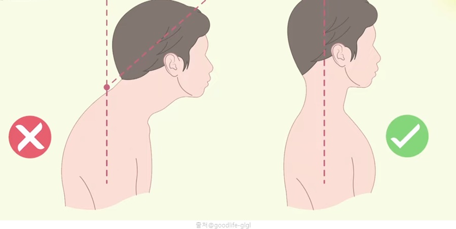 목디스크 운동 치료방법 바른 자세 방법 거북목 교정 일자목 스트레칭 목운동