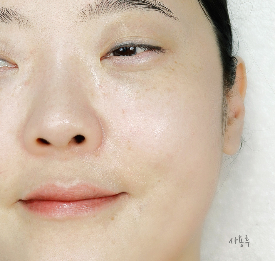 피부관리기 메디테라피 블루레이어 앰플젯 얼굴홍조 진정