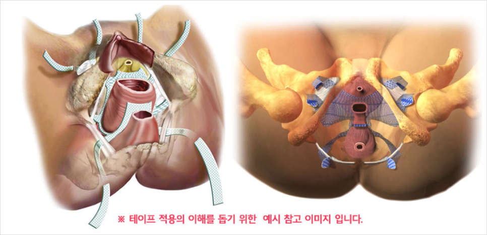 요실금수술 입원? 필요 없습니다. (19년차 의사의 설명)