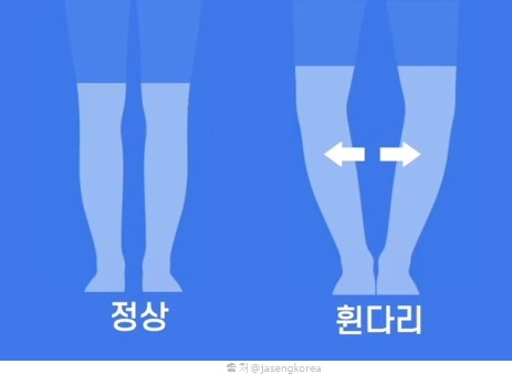 다리 살빼는 운동 다리묶기 책벅지 벽에 다리 올리기 오다리교정 스트레칭 효과