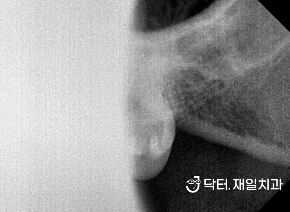 서울 일요일 사랑니발치 치과에서 증상과 통증있어서 무서운 환자분들도 수면내시경방식으로 잠자면서 편안하게 feat.과잉치발치