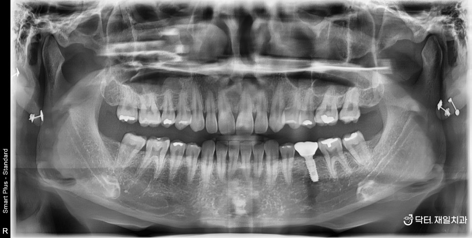 턱관절 및 이갈이장치를 통해서 악관절 턱근육통증으로부터  치아를 보호해야합니다 ! 암사동 천호동이갈이 이악물기 feat. 수면용 마우스피스 스플린트후기