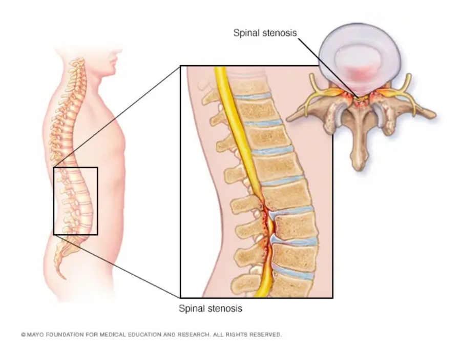 척추 협착증 원인, 증상, 예방 및 치료