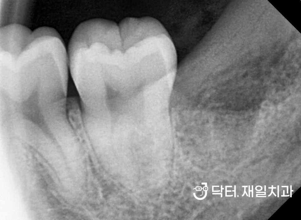 서울사랑니치과 추천받는 치과의사가 알려드리는 매복사랑니발치 비용 가격 2024 version ! 통증 증상으로 무서운 분들 수면상태 의식하진정법으로 잠자면서 한번에 빼세요