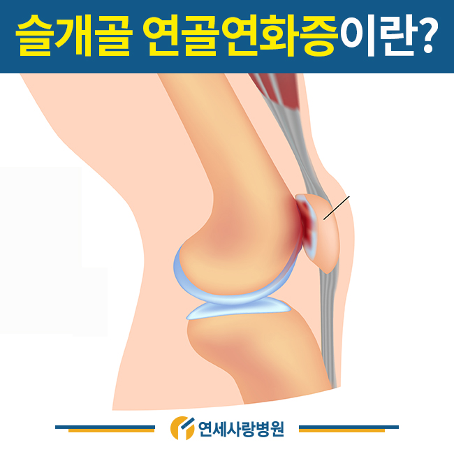 왼쪽 무릎통증 원인, 연골연화증 증상 주의해야