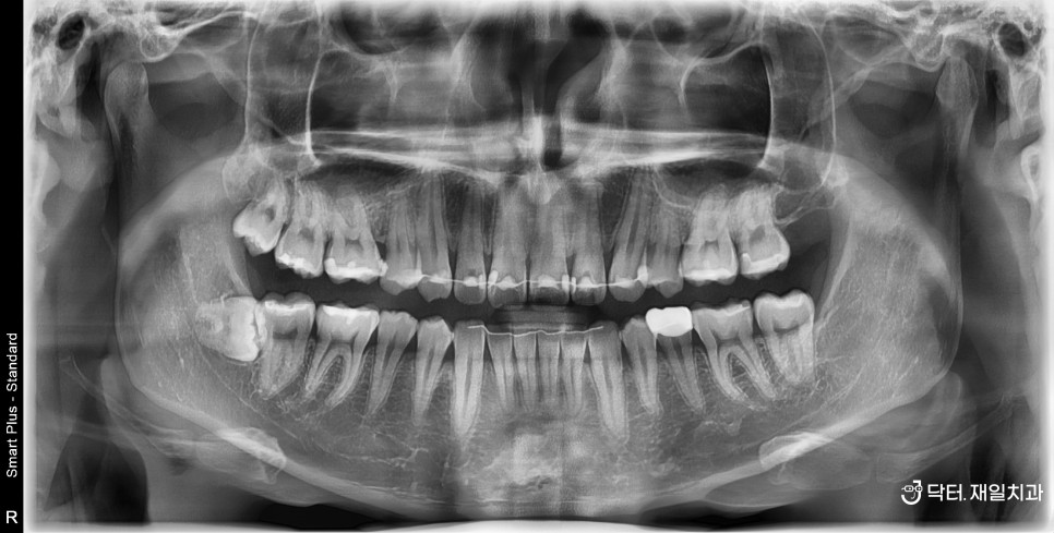 치과공포증 환자분들이 치과치료를 미루는 이유 1위 "무서워서 못오다가 치아가 망가졌어요" 트라우마 해결방법은 분명 있습니다