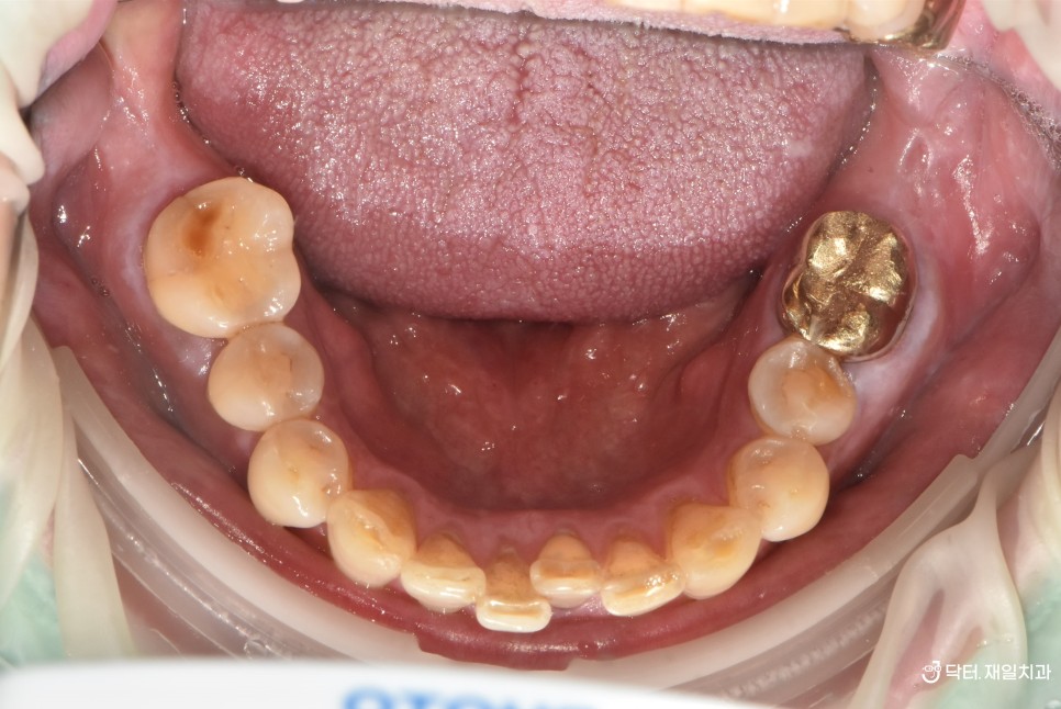 발치즉시임플란트 당일 가능했던 치아뿌리 파절 부러짐 있을때 CT상에 알파벳 J 모양으로 잇몸염증 생긴 경우 ! 성내동 길동치과 임플란트수술