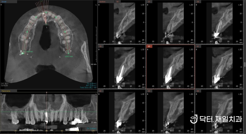 발치즉시임플란트 당일 가능했던 치아뿌리 파절 부러짐 있을때 CT상에 알파벳 J 모양으로 잇몸염증 생긴 경우 ! 성내동 길동치과 임플란트수술