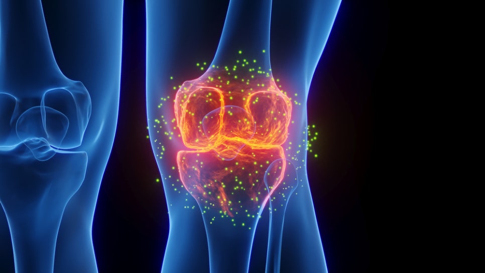 [건강정보] 무릎 앞 통증 반복된다면 슬개골연골연화증? (+예방 방법)