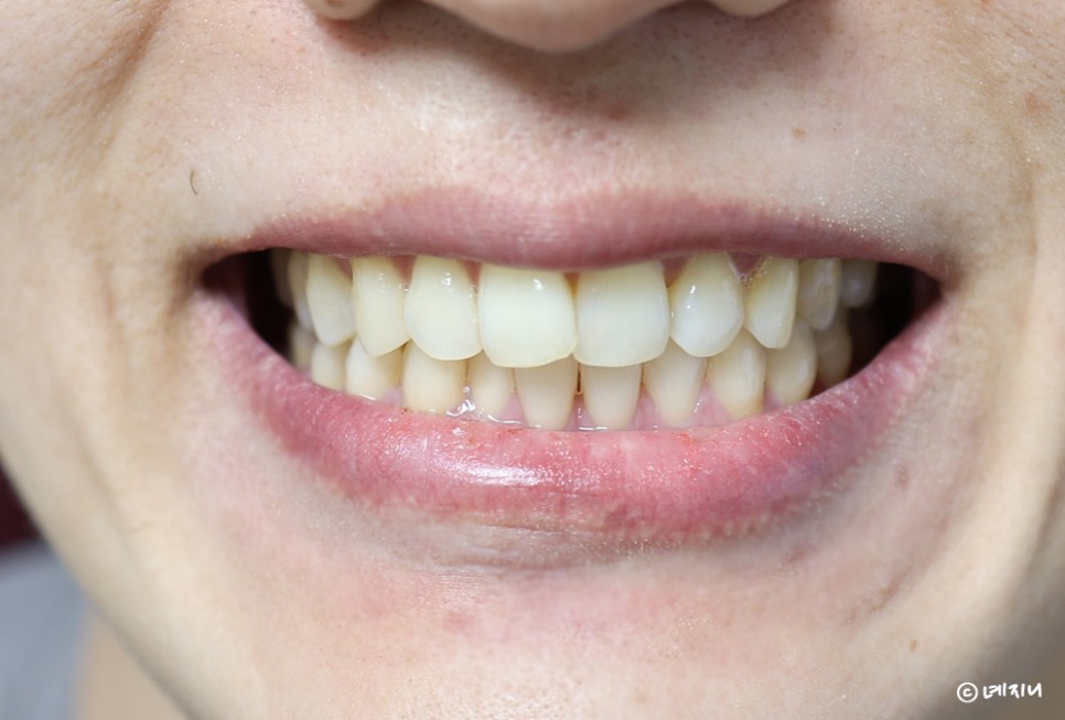 올리브영 셀프치아미백 치과의사가 개발한 라이브오랄스 사용법 후기