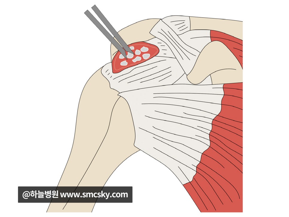 석회성건염(석회화건염) 증상 및 어깨통증 원인 치료, 압통