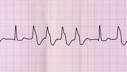 심장 두근거림(심계항진)의 일반적인 원인