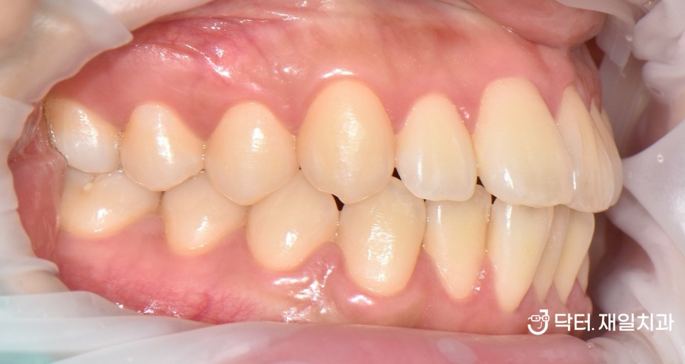 앞니교정 치과에서 삐뚤빼뚤한 치아도 철사없이 치료하는 투명교정의 대표적인 인비절라인 가격 비용