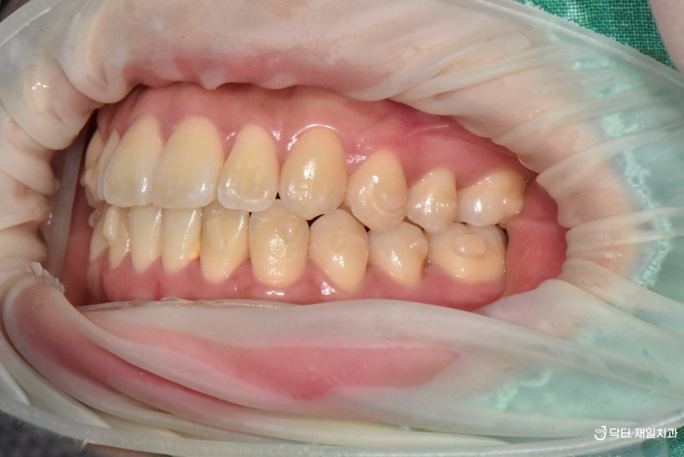 앞니교정 치과에서 삐뚤빼뚤한 치아도 철사없이 치료하는 투명교정의 대표적인 인비절라인 가격 비용