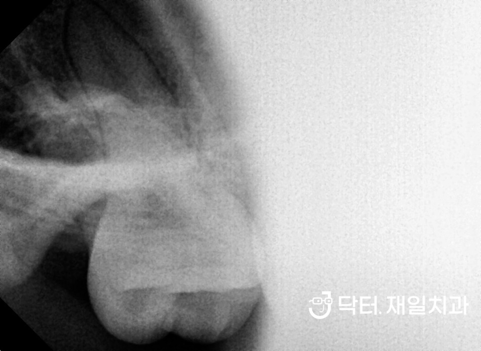 매복사랑니 발치 누워있는 경우 또는 매복아닌 경우라도 꼭 해야하는 이유 ! 음식물 끼고 구취생겨서 수면으로 4개 한번에 뽑은 후기