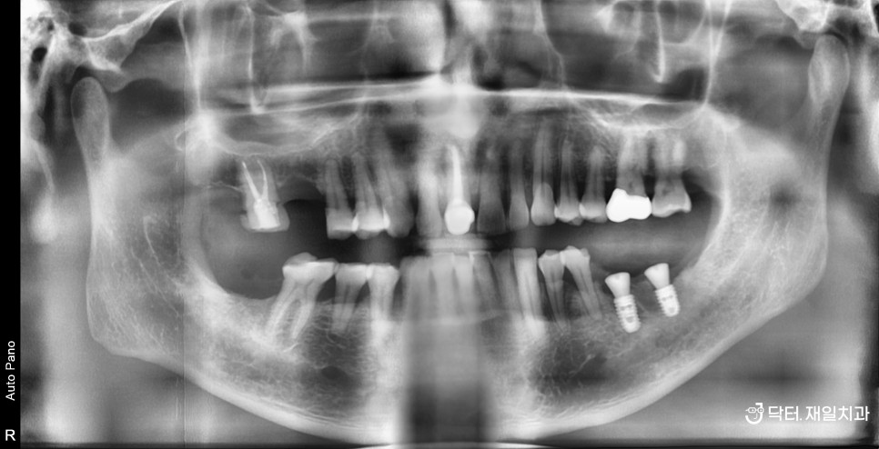 발치즉시임플란트 당일 가능했던 치아뿌리 파절 부러짐 있을때 CT상에 알파벳 J 모양으로 잇몸염증 생긴 경우 ! 성내동 길동치과 임플란트수술