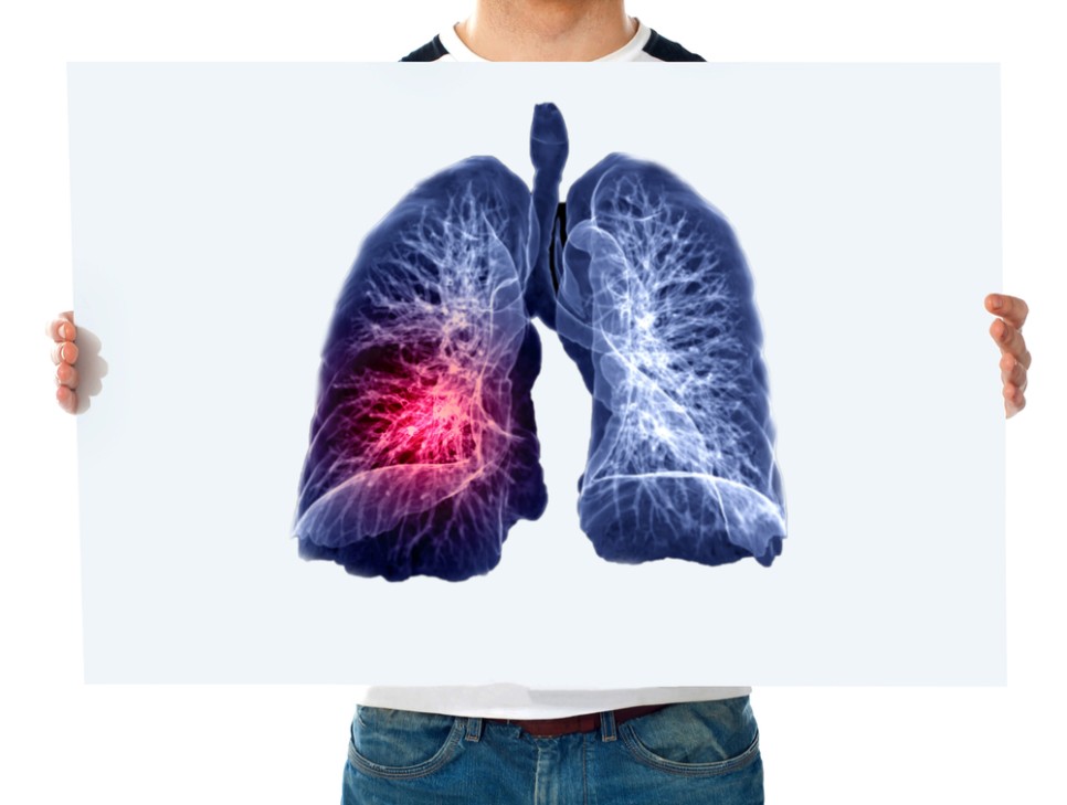 [건강검진] 폐렴 진단 방법과 검사 종류 알아보기 (+ 폐기능 검사)