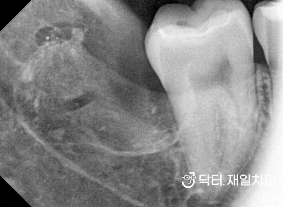 치과공포증 환자분들이 치과치료를 미루는 이유 1위 "무서워서 못오다가 치아가 망가졌어요" 트라우마 해결방법은 분명 있습니다