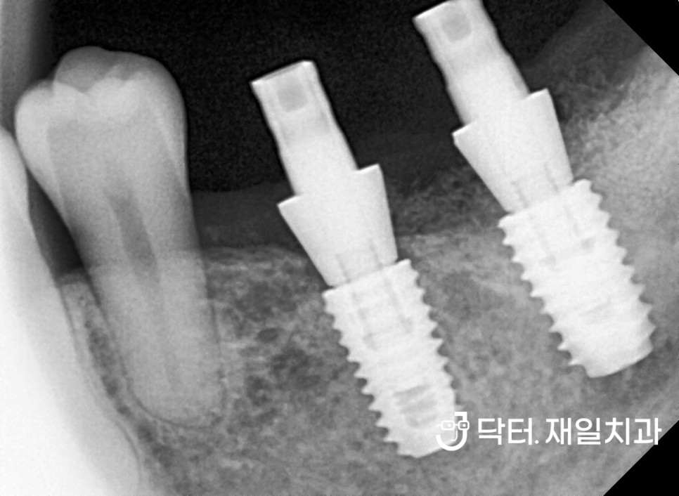 어금니 전체임플란트 수술이 필요한 20대 30대 치과공포증 환자분들도 수면마취 시스템으로 숙면을 취하며 여러가지 치료를 동시에 천호역 암사역치과에서