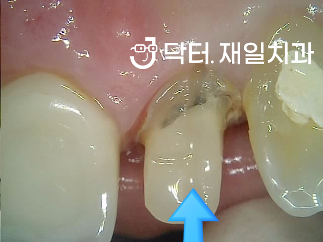 앞니크라운 재치료를 통한 심미보철 교체 후 지르코니아 씌우기 ! 치아뿌리염증으로 잇몸고름주머니 생긴 경우 재신경치료 및 치근단절제술로 성공률 높였어요