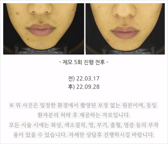 청주남자레이저제모, 10회만에 끝낼 수 있을까? - 9년차 의사 답변