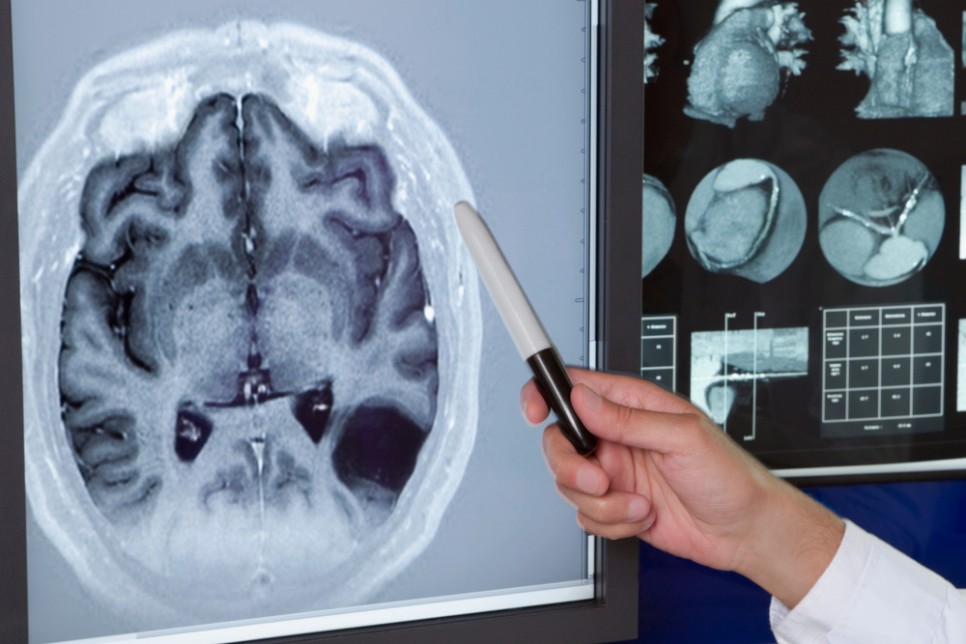 [건강검진] 증상에 따라 권장되는 뇌 정밀검사 종류(MRI+MRA+뇌위축도)