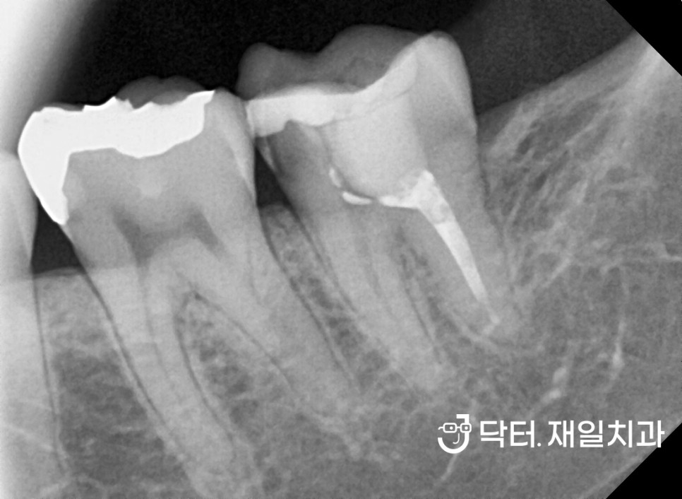 충치통증과 치수염으로 갑자기 앞니 어금니 치통이 심할때 신경치료 하루만에 시작부터 끝까지 수면마취로 완료 후 크라운치료까지 ! 천호동 암사동재신경치료