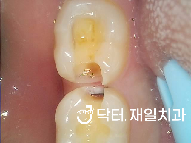 충치통증과 치수염으로 갑자기 앞니 어금니 치통이 심할때 신경치료 하루만에 시작부터 끝까지 수면마취로 완료 후 크라운치료까지 ! 천호동 암사동재신경치료