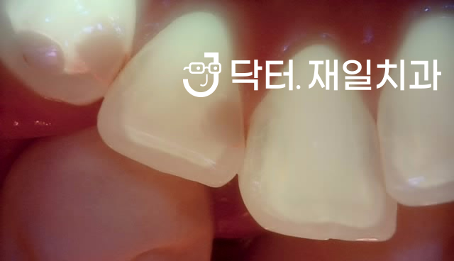 충치통증과 치수염으로 갑자기 앞니 어금니 치통이 심할때 신경치료 하루만에 시작부터 끝까지 수면마취로 완료 후 크라운치료까지 ! 천호동 암사동재신경치료