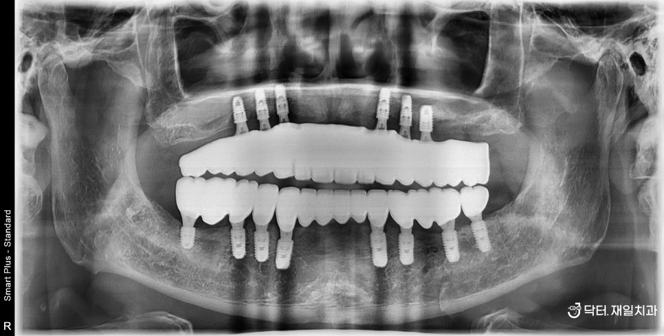 강동구임플란트 ! 저희 치과에 전라도 광주에 사시는 70대 직원 아버님이 오셔서 수면마취 의식하진정법으로 전악발치 후 전체임플란트수술 원데이로 받으신 후기 feat. 상악 매직4