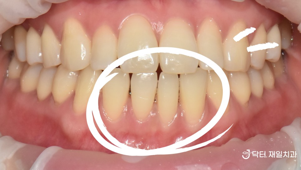잇몸내려앉음 치료와 원인 ! 치경부마모증은 때우고, 염증 크랙으로 잇몸부었을때 발치 또는 씌우고, 퇴축되었을때 잇몸이식