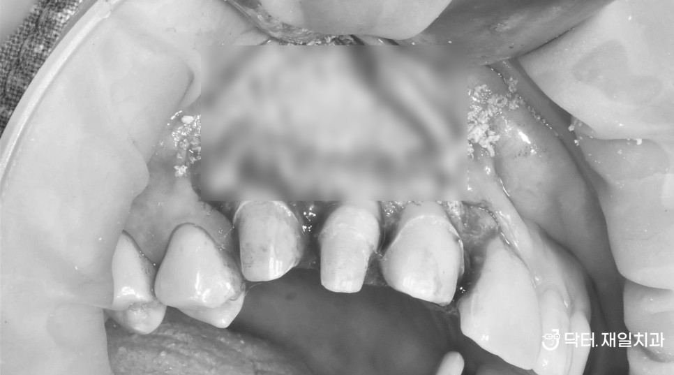 치아뿌리염증과 물혹(치근낭)으로 인해 앞니 잇몸염증고름주머니가 큰 물집처럼 잡히고 입천장부음 증상 있어도 이빼지않고 치근단절제술과 뼈이식을 통해 해결 feat. 수면마취로 하루에