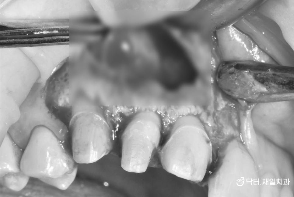 치아뿌리염증과 물혹(치근낭)으로 인해 앞니 잇몸염증고름주머니가 큰 물집처럼 잡히고 입천장부음 증상 있어도 이빼지않고 치근단절제술과 뼈이식을 통해 해결 feat. 수면마취로 하루에