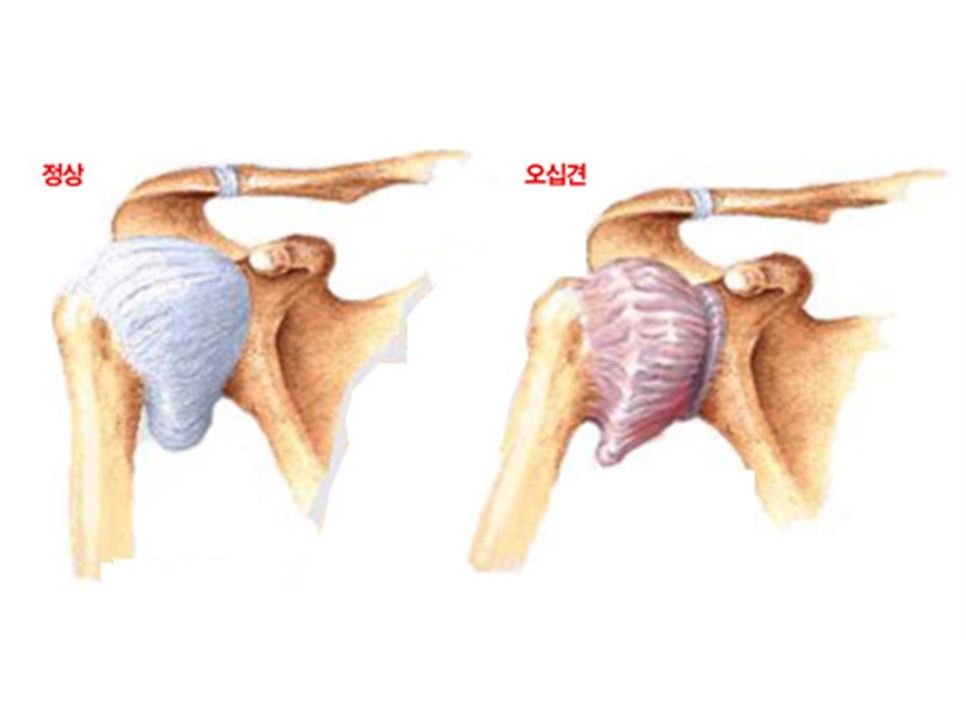 왼쪽, 오른쪽 어깨통증 원인 및 증상 질환(어깨가 아파요)