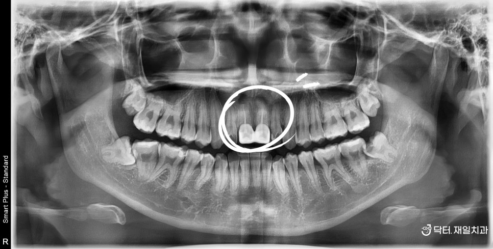 앞니재신경치료를 통해 이빨뿌리염증을 치료하고 PFM크라운을 지르코니아 크라운으로 변경 ! 방이동 풍납동치과에서 가까운 저희 치과