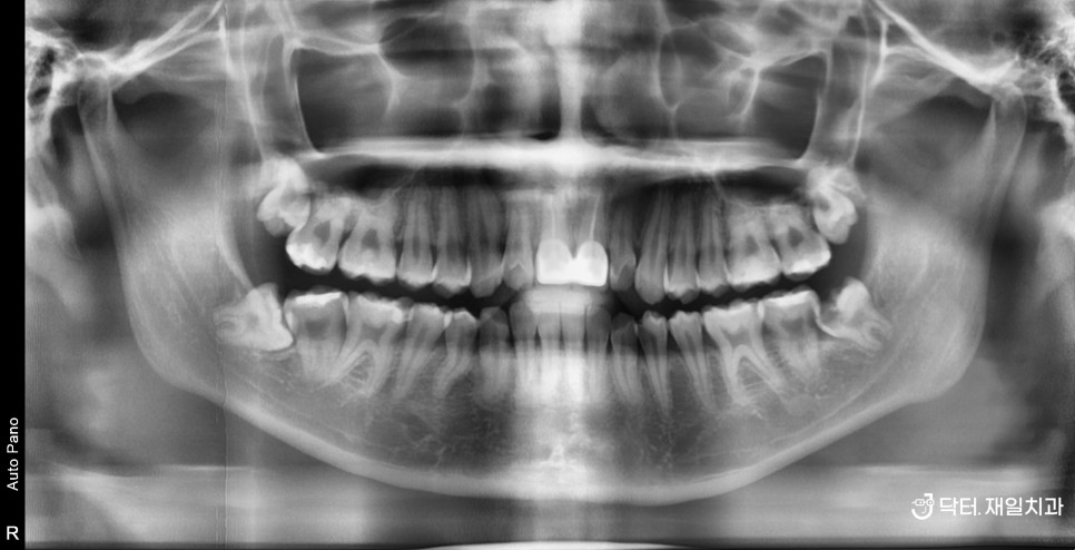 앞니재신경치료를 통해 이빨뿌리염증을 치료하고 PFM크라운을 지르코니아 크라운으로 변경 ! 방이동 풍납동치과에서 가까운 저희 치과