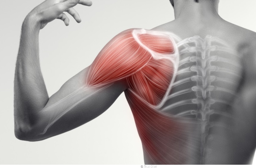 어깨통증 원인 어깨 회전근개파열 운동 오십견운동법