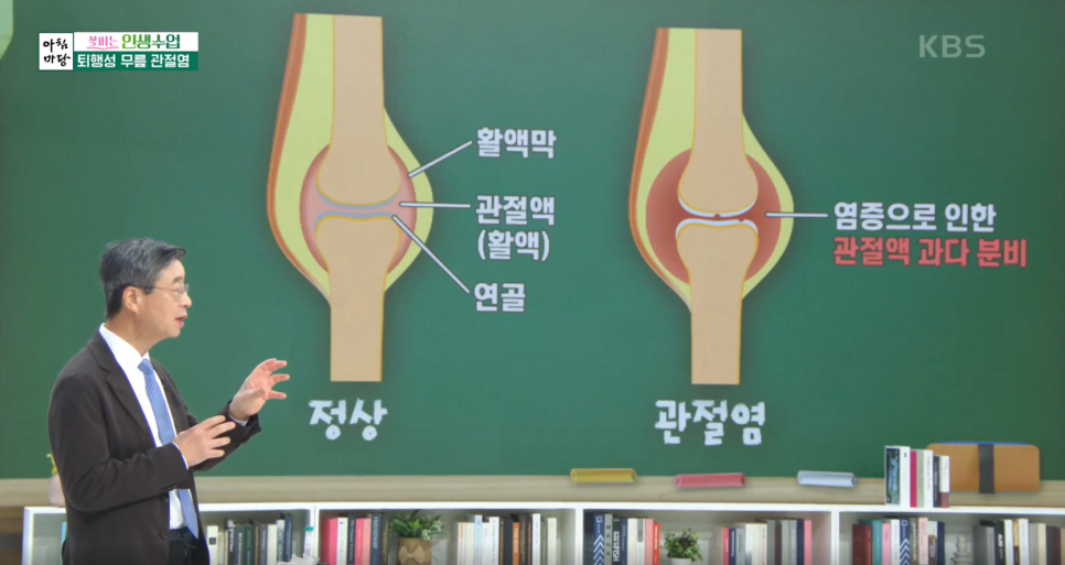 KBS 아침마당 연세사랑병원 고용곤 병원장 퇴행성관절염 특강 진행