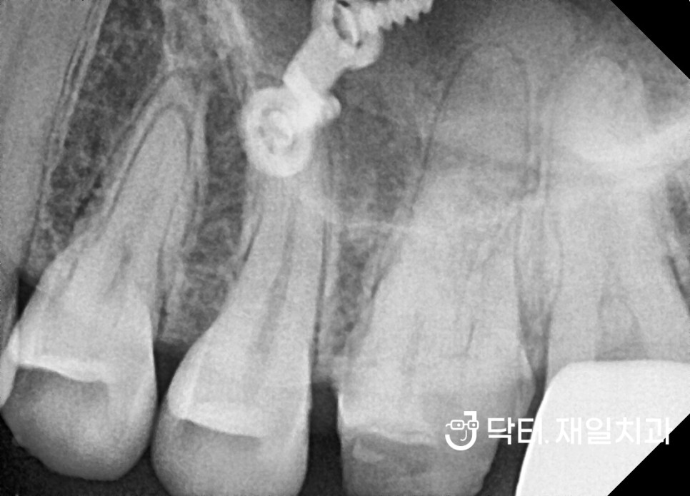 오래된 금니 깨짐 떨어짐 탈락이 발생한 경우에 금인레이 주위에 충치나 치아크랙이 있다면 어금니크라운치료가 필요할 수 있습니다